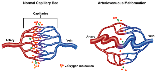 Arterio-Venous Malformations - Society of Vascular and Interventional